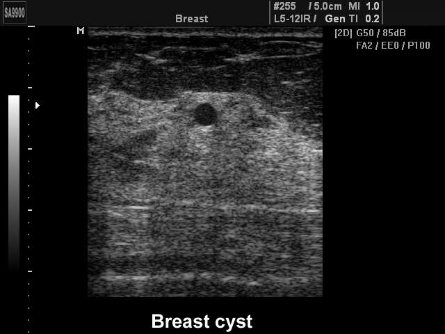 Киста молочной железы, B-режим (эхограмма №221)