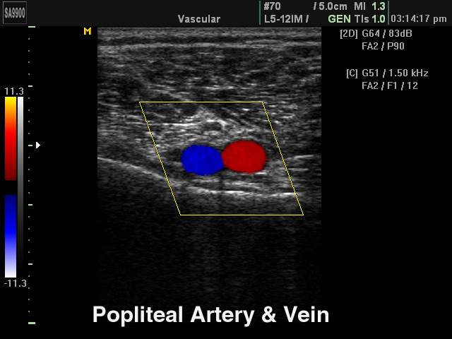 Подколенная артерия и вена, цветное картирование (эхограмма №224)