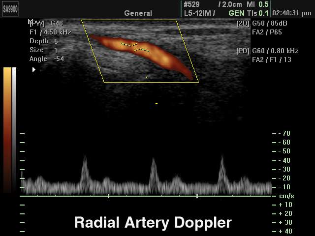 Лучевая артерия, PD и PW (эхограмма №226)