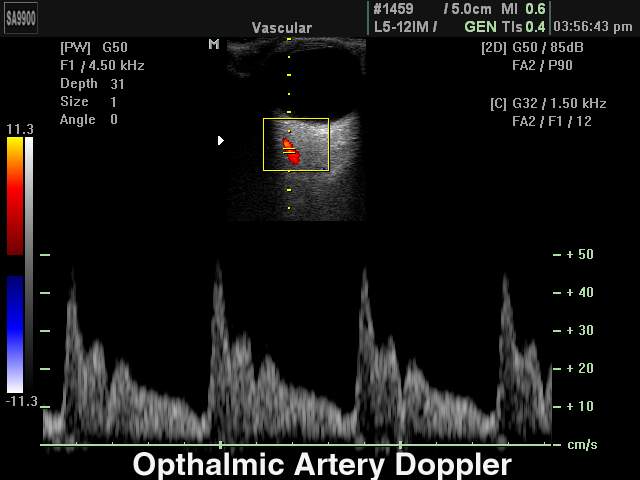 Артерия глаза, CFM и PW (эхограмма №227)