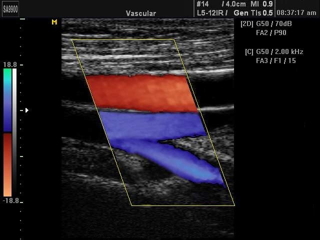 Поверхностная бедренная артерия, цветное картирование (эхограмма №228)