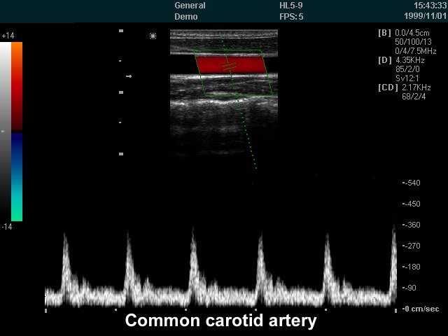 Общая сонная артерия, CFM и PW (эхограмма №238)