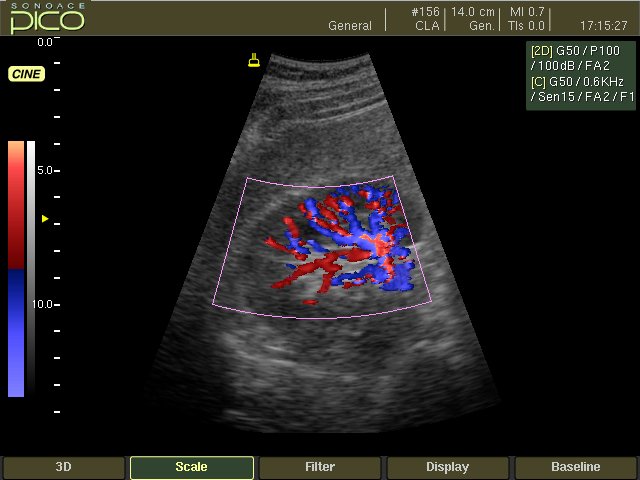Почка, цветное картирование (эхограмма №244)