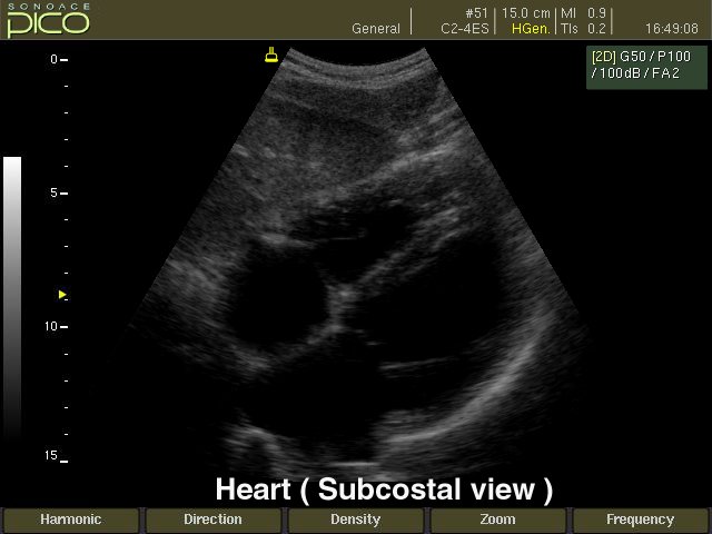 Сердце (субкостальный доступ), B-режим (эхограмма №246)