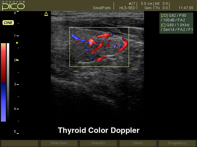 Щитовидная железа, цветной допплер (эхограмма №265)