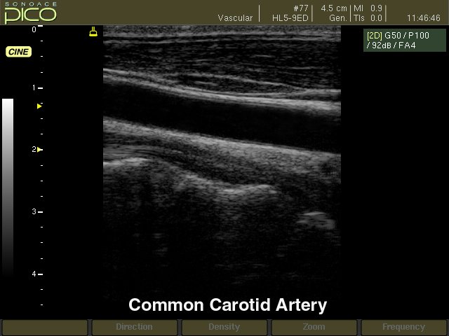 Общая сонная артерия, B-режим (эхограмма №266)