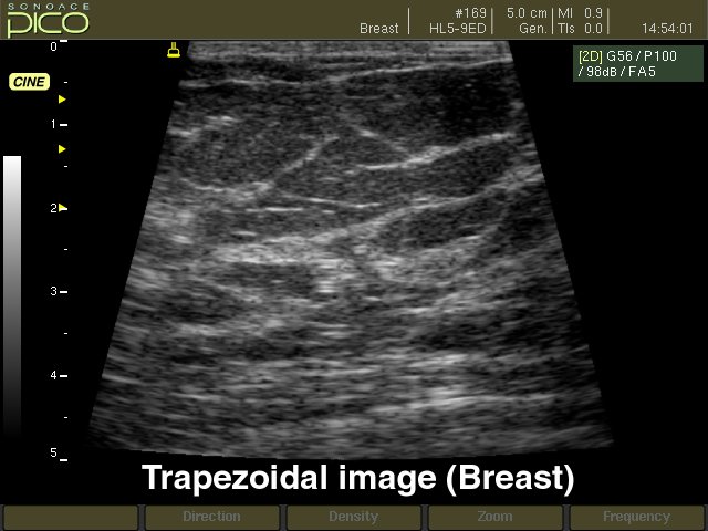 Молочная железа, трапецеидальный B-режим (эхограмма №271)