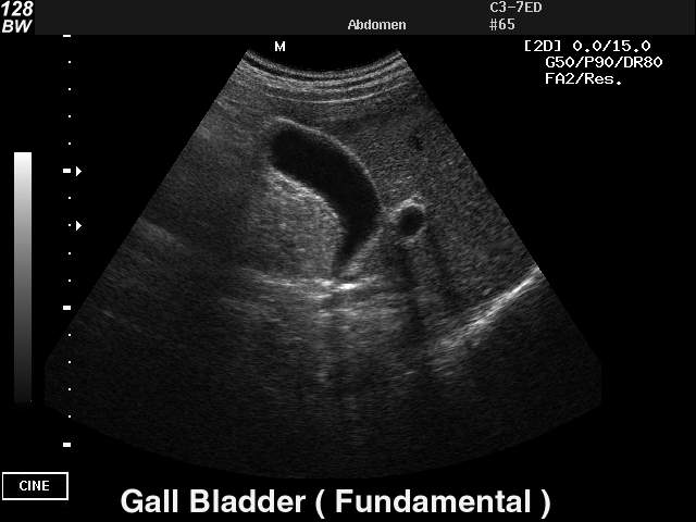 Желчный пузырь - базовая гармоника, B-режим (эхограмма №28)