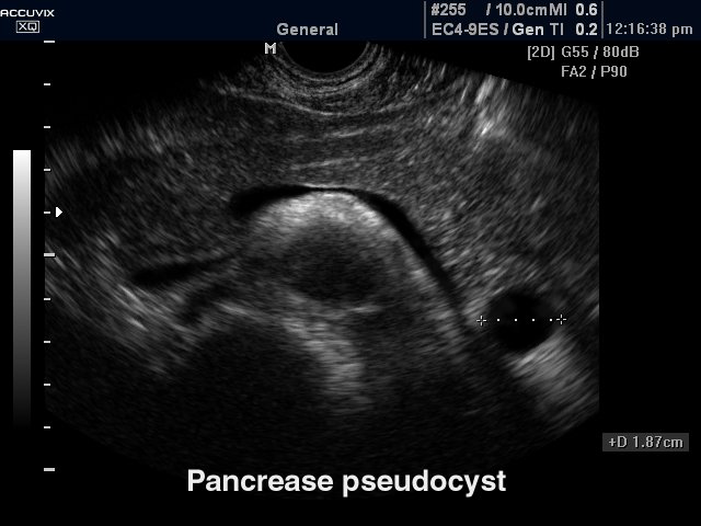 Псевдокиста поджелудочной железы, B-режим (эхограмма №286)