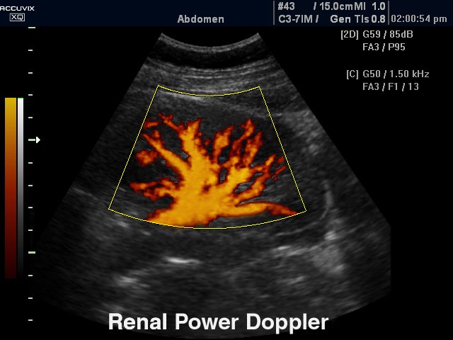 Почка, энергетический допплер (эхограмма №289)