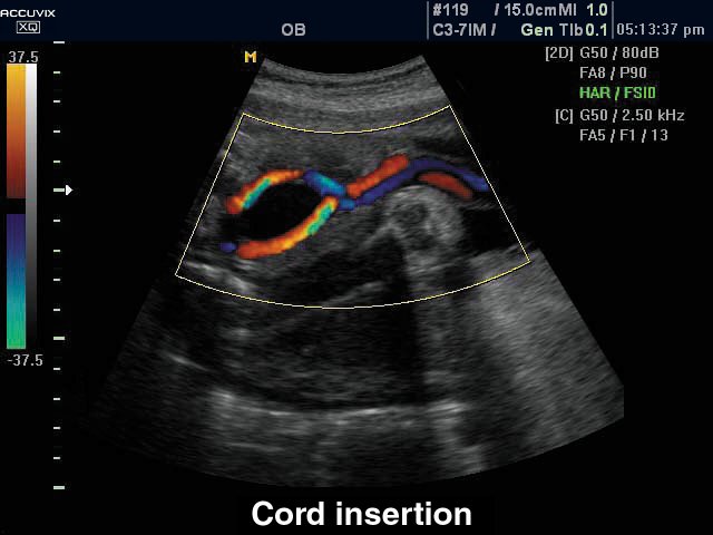 Оболочечное прикрепление пуповины, цветное картирование (эхограмма №306)