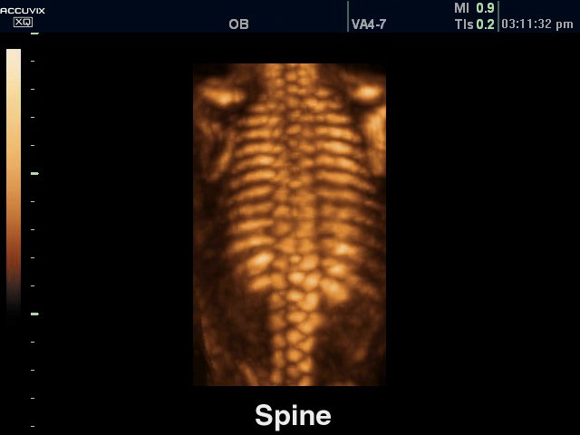 Позвоночник плода, 3D (эхограмма №316)
