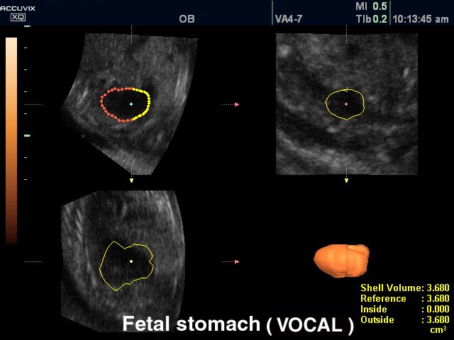 Желудок плода, VOCAL (эхограмма №317)