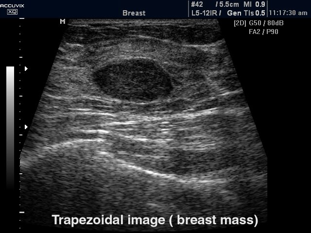 Узел в молочной железе, трапециедальный режим (эхограмма №322)