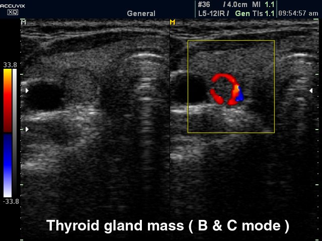 Узел щитовидной железы, B-режим и ЦДК (эхограмма №323)