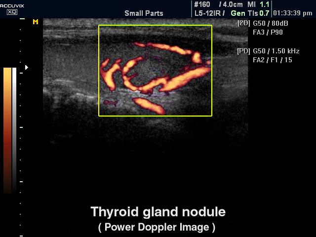Узел щитовидной железы, энергетический допплер (эхограмма №324)