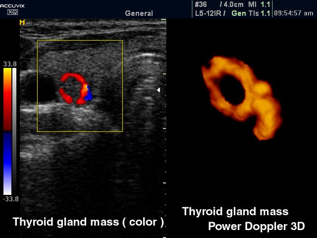 Узел щитовидной железы, ЦДК и энергетический допплер в 3D (эхограмма №325)