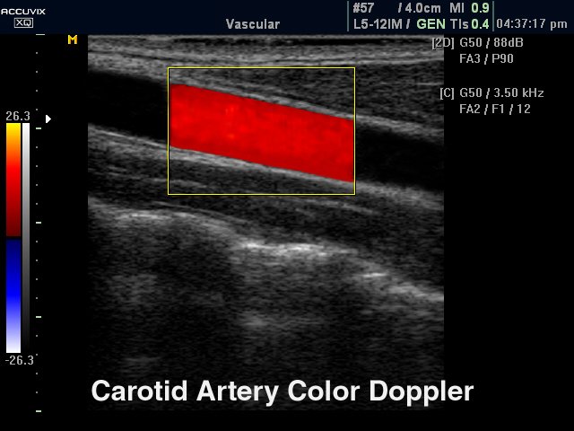 Общая сонная артерия, цветное картирование (эхограмма №328)