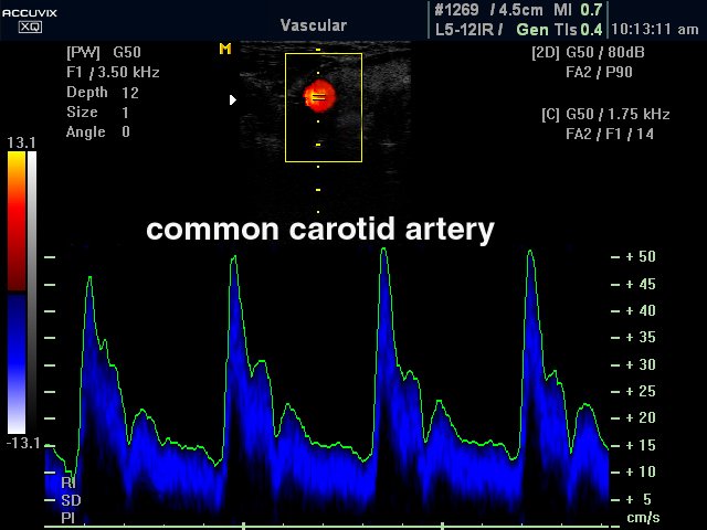 Общая сонная артерия, CFM и PW (эхограмма №329)