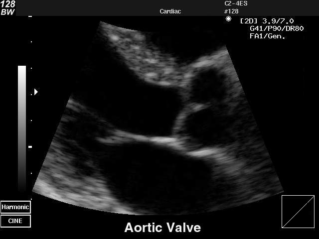 Аортальный клапан, B-режим (эхограмма №33)