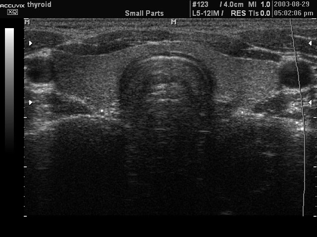 Щитовидная железа, B-режим (эхограмма №330)