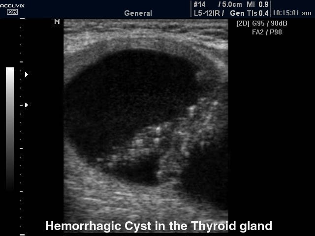 Щитовидной железа - геморрагическая киста, B-режим (эхограмма №331)
