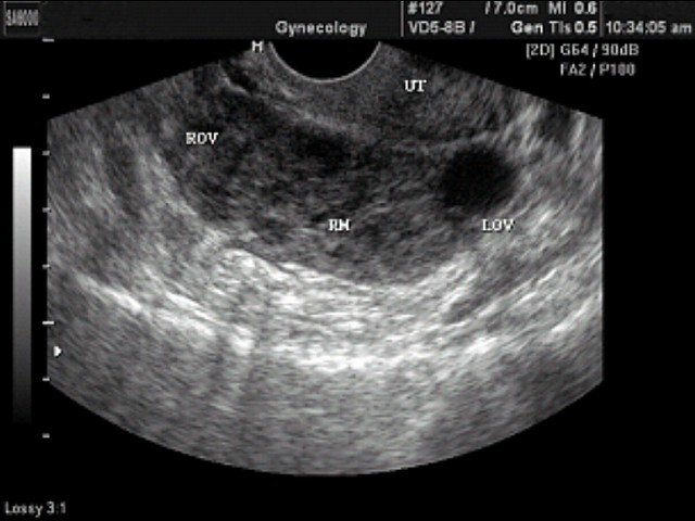 Внематочная беременность, B-режим (эхограмма №349)