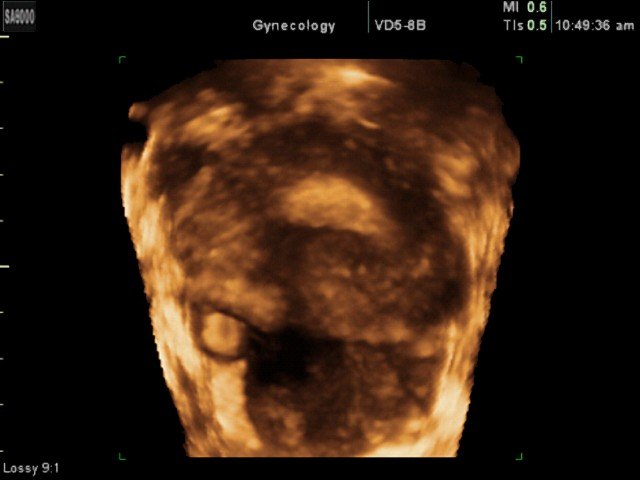 Внематочная беременность, 3D (эхограмма №351)