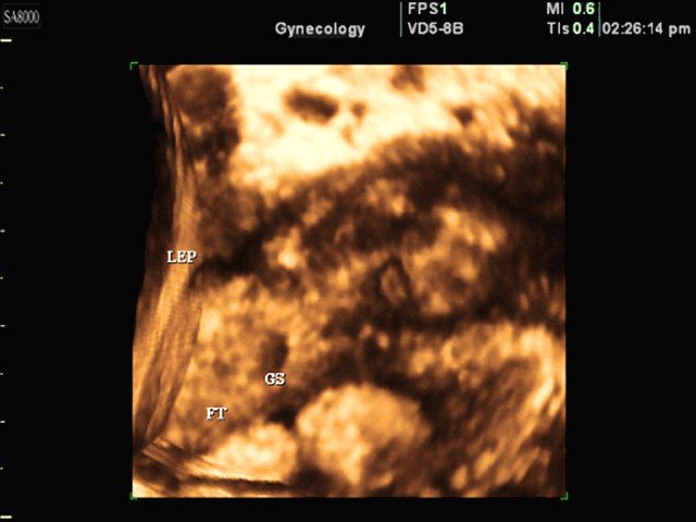 Внематочная беременность - расширение фаллопиевых труб, 3D (эхограмма №354)