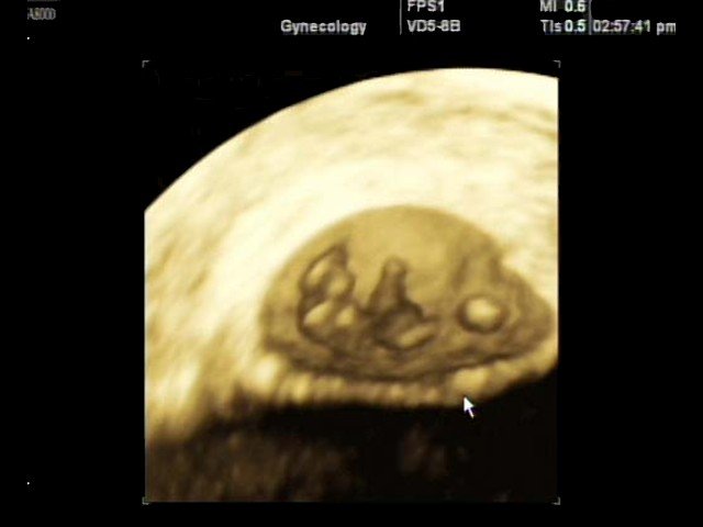 Многоплодная беременность - двойня, 3D (эхограмма №357)