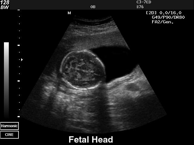 Голова плода, B-режим (эхограмма №37)