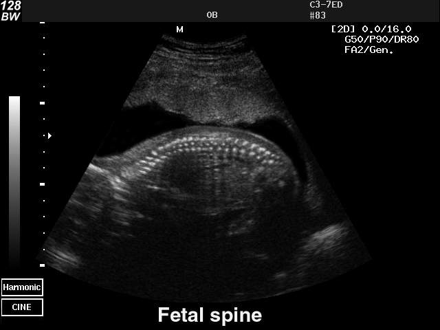 Позвоночник плода, B-режим (эхограмма №40)