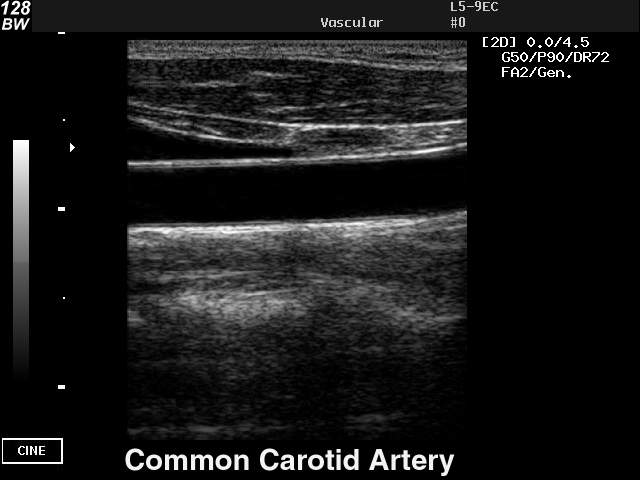 Общая сонная артерия, B-режим (эхограмма №41)