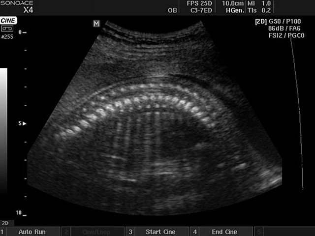 Плод - позвоночник, B-режим (эхограмма №414)
