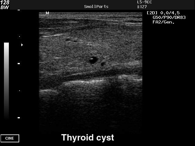 Киста щитовидной железы, B-режим (эхограмма №42)