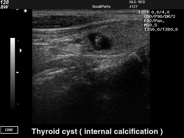 Щитовидная железа - киста с кальцификатом, B-режим (эхограмма №43)