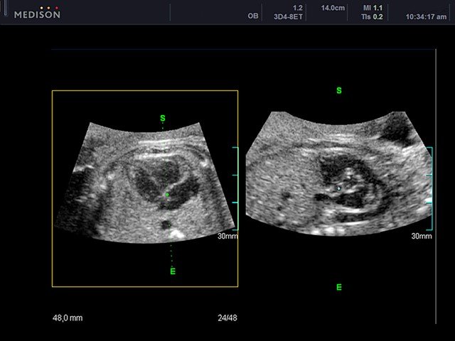 Сердце плода - косой срез, B-режим (эхограмма №440)