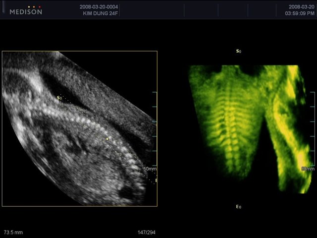 Позвоночник плода, OVIX и 3D (эхограмма №448)