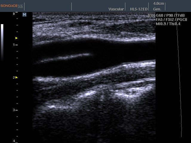Общая сонная артерия - бифуркация, B-режим (эхограмма №460)