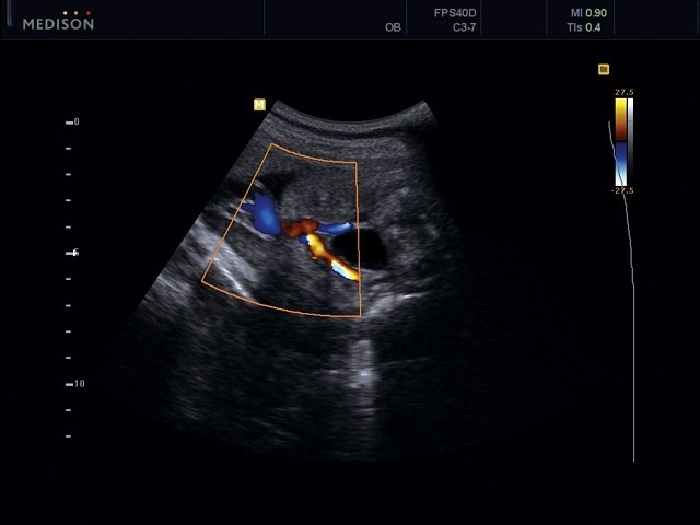 Мочевой пузырь и 2 артерии пуповины, энергетический допплер (эхограмма №464)