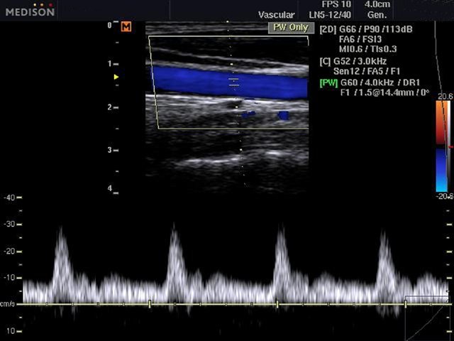 Общая сонная артерия, CFM и PW (эхограмма №476)