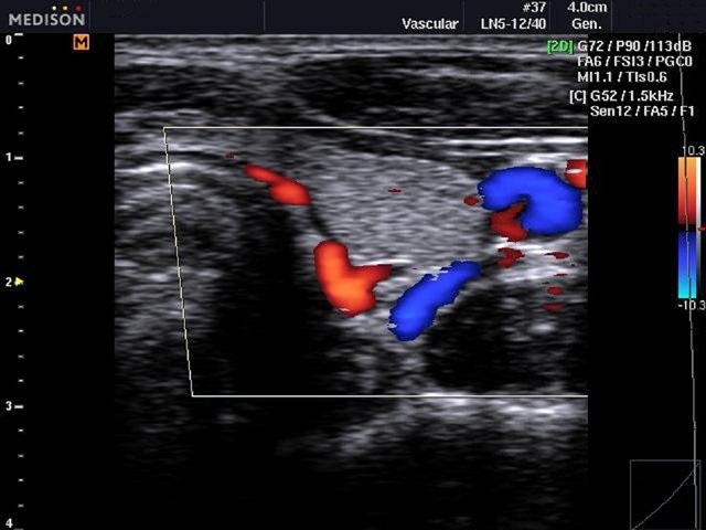 Щитовидная железа и ОСА, цветное картирование (эхограмма №477)