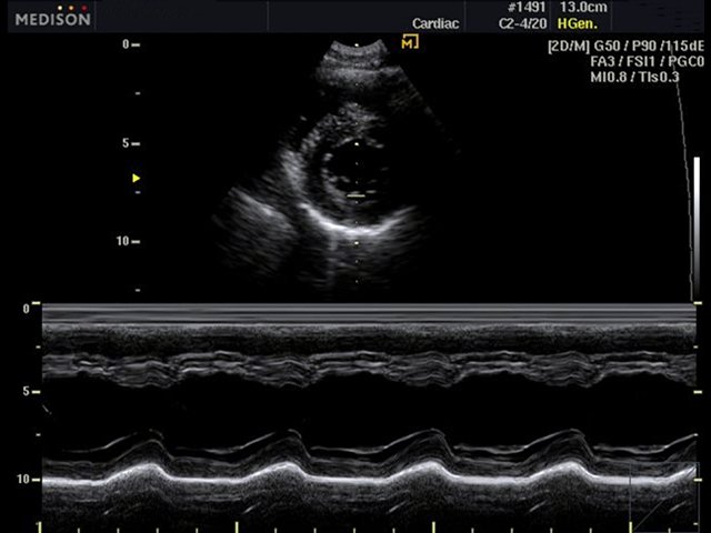 Сердце - левый желудочек, M-режим (эхограмма №485)