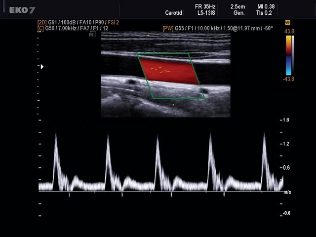 Общая сонная артерия, CFM и PW (эхограмма №491)