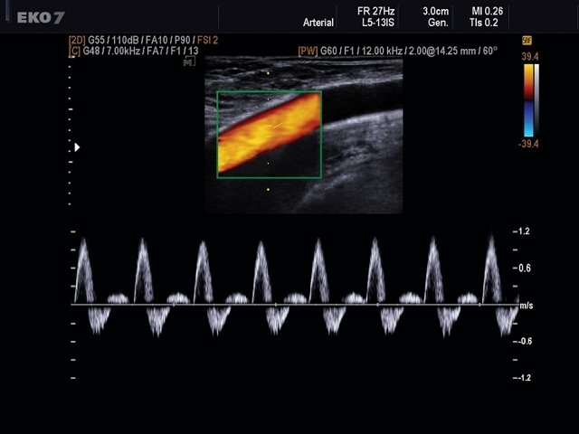 Бедренная артерия, CFM и PW (эхограмма №493)