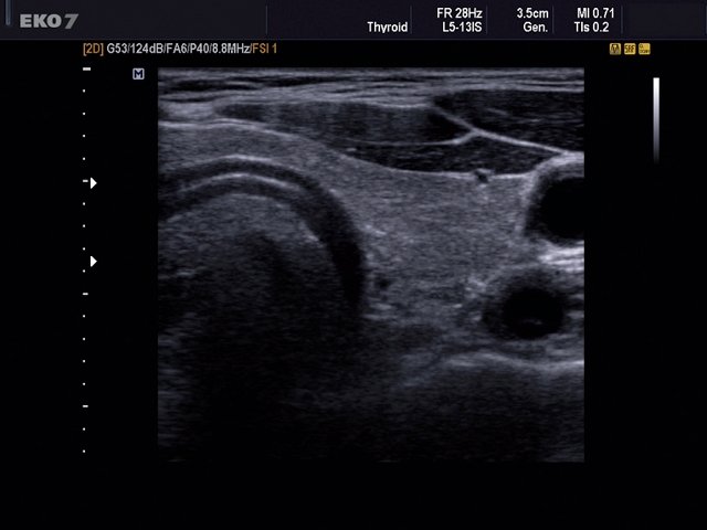 Щитовидная железа, B-режим (эхограмма №497)