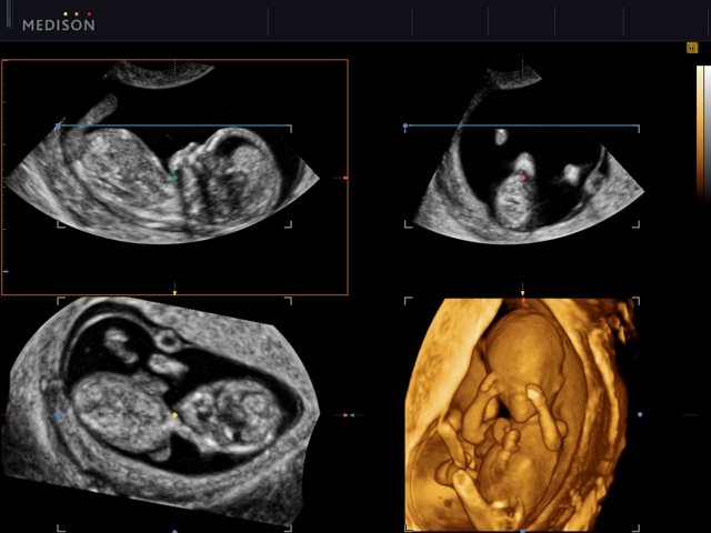 Плод - 13 недель, MPR, HDVI (эхограмма №512)
