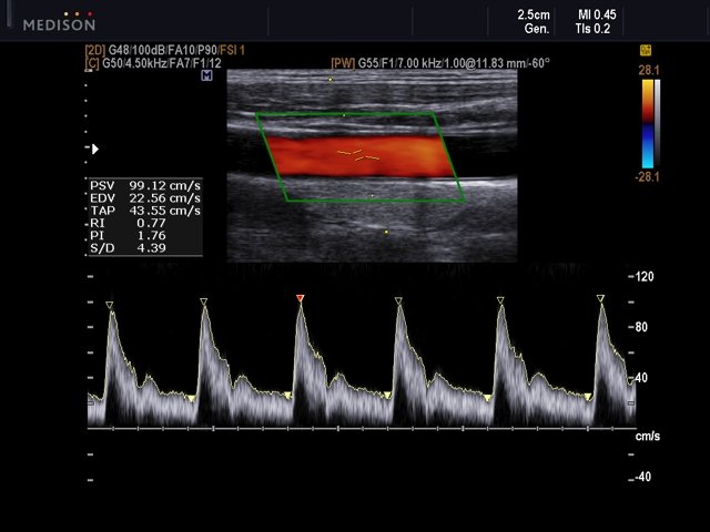 Общая сонная артерия, CFM и PW (эхограмма №524)