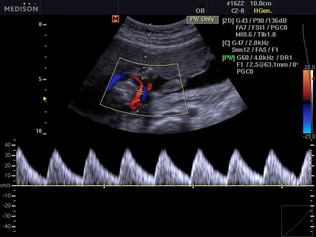 Плод - артерия пуповины, CFM и PW (эхограмма №527)