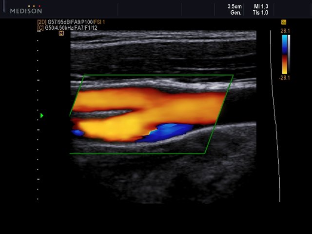 Общая сонная артерия - бифуркация, цветной допплер (эхограмма №534)